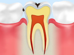 C1（エナメル質のむし歯）